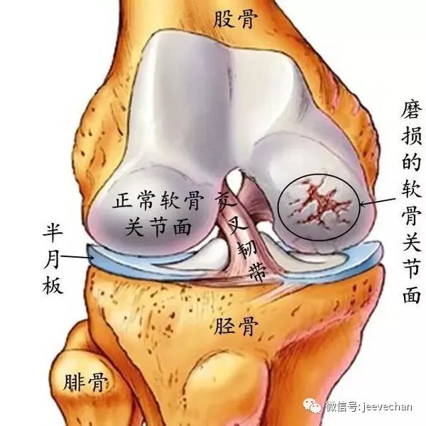 前交叉韧带损伤原因_膝关节反复扭伤预防_前交叉韧带nba